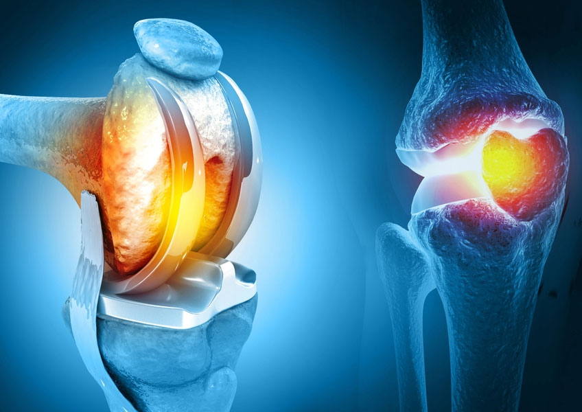 Arthroplasty Joint Replacement