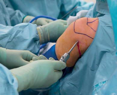 Minimally Invasive Surgery
